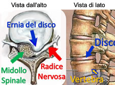 Schema lombalgia